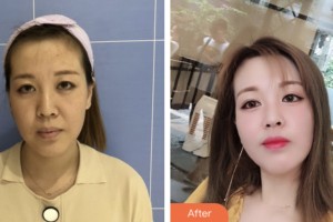 荊門(mén)市第二人民醫(yī)院醫(yī)學(xué)整形美容中心金娟娟整形價(jià)格表附埋線提升案例展示