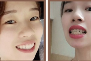 荊門(mén)市第二人民醫(yī)院醫(yī)學(xué)整形美容中心葉君整形價(jià)格表附冷光美白案例展示