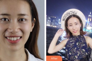 荊門(mén)小白兔口腔醫(yī)院趙宗富整形價(jià)格表附牙齒隱形矯正案例展示