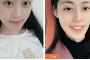 荊門(mén)好美醫(yī)療美容醫(yī)院葉華整形價(jià)格表附美白貼片案例展示