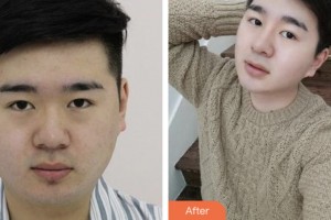 株洲藝佳醫(yī)療美容?？漆t(yī)院李文軍整形價格表附假體隆鼻案例展示