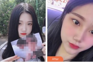 株洲藝佳醫(yī)療美容?？漆t(yī)院高謝輝整形價格表附耳軟骨復合隆鼻案例展示