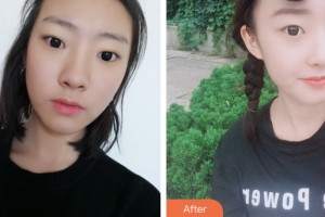 株洲宇芳姬醫(yī)療美容門(mén)診部鄭蕎安整形價(jià)格表附鼻部綜合案例展示