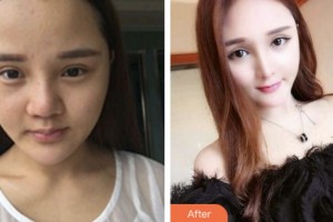 株洲宇芳姬醫(yī)療美容門(mén)診部李鶴整形價(jià)格表附鼻部綜合案例展示