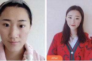 株洲雅美醫(yī)療美容門(mén)診部黃益卯整形價(jià)格表附鼻部綜合案例展示