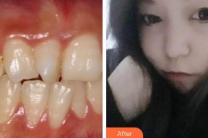 泰州玲瓏口腔門診部張錦整形價格表附牙齒隱形矯正案例展示