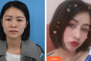 湘潭陽(yáng)光整形美容門(mén)診部劉洋整形價(jià)格表附肋軟骨隆鼻案例展示