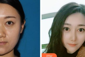 湘潭雅美醫(yī)療美容醫(yī)院楊奇元整形價(jià)格表附耳軟骨復(fù)合隆鼻案例展示