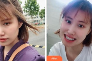 永州中南口腔醫(yī)院馬賀整形價(jià)格表附金屬托槽矯正案例展示
