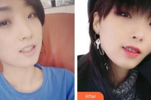 永州國斌口腔門診部劉阿寶整形價(jià)格表附金屬托槽矯正案例展示