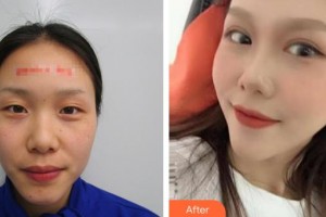永州愛爾眼科醫(yī)院伍俊整形價(jià)格表附切開雙眼皮案例展示