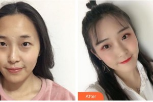 永州愛爾眼科醫(yī)院雷林國整形價(jià)格表附切開雙眼皮案例展示