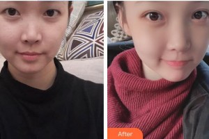 永州市第一人民醫(yī)院眼科魏蓉整形價(jià)格表附眼部綜合案例展示