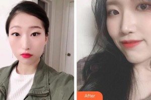 順德愛爾眼科醫(yī)院林為華整形價(jià)格表附眼部綜合案例展示