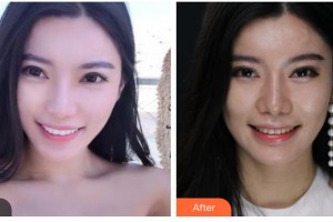 榆林婦產(chǎn)?？漆t(yī)院韓式整形美容中心劉軼整形價(jià)格表附美白貼片案例展示