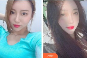 榆林婦產(chǎn)?？漆t(yī)院韓式整形美容中心宋寶強(qiáng)整形價(jià)格表附切開(kāi)雙眼皮案例展示