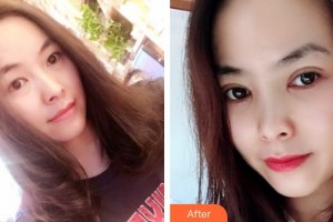 慶陽華美醫(yī)療美容診所張翰理整形價(jià)格表附切開雙眼皮案例展示