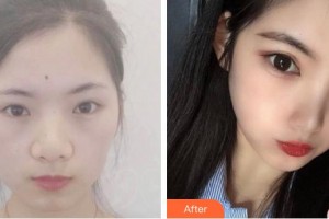 慶陽天成整形外科醫(yī)院王天成整形價(jià)格表附切開雙眼皮案例展示