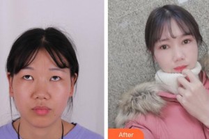 慶陽華美醫(yī)療美容診所張萬春整形價(jià)格表附眼部綜合案例展示