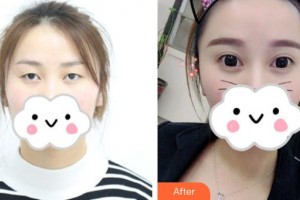 慶陽華美醫(yī)療美容診所田輝整形價(jià)格表附眼部綜合案例展示