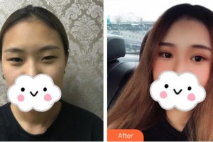 慶陽市第二人民醫(yī)院眼科楊國珍整形價(jià)格表附眼部綜合案例展示