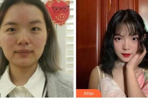 慶陽市第二人民醫(yī)院眼科王芳寧整形價(jià)格表附眼部綜合案例展示