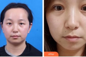 隴南市中醫(yī)醫(yī)院眼科余良智整形價(jià)格表附眼部綜合案例展示
