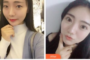 隴南市中醫(yī)醫(yī)院眼科胡月皎住院醫(yī)師整形價(jià)格表附切開雙眼皮案例展示