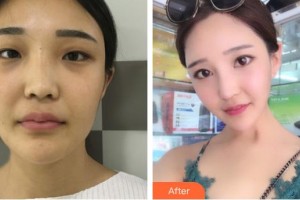 天水瑪莉亞（原女子）醫(yī)院醫(yī)學(xué)整形中心徐明整形價格表附鼻部綜合案例展示