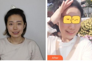 天水瑪莉亞（原女子）醫(yī)院醫(yī)學(xué)整形中心郭莉整形價格表附牙齒隱形矯正案例展示