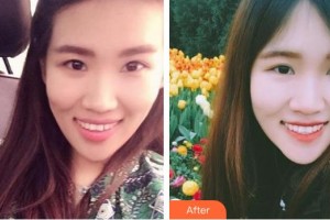 天水瑪莉亞（原女子）醫(yī)院醫(yī)學(xué)整形中心李兆鶴整形價格表附牙齒隱形矯正案例展示