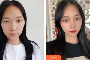 義烏愛(ài)爾眼科醫(yī)院陳曉華整形價(jià)格表附眼部綜合案例展示