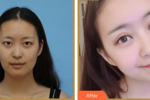 義烏愛(ài)爾眼科醫(yī)院戴襄軍整形價(jià)格表附眼部綜合案例展示