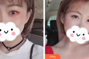 滕州市財貿醫(yī)院眼科張悅玲整形價格表附眼部綜合案例展示