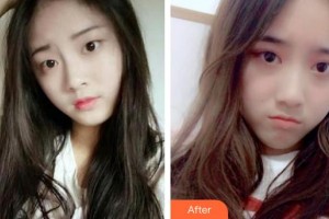 滕州啟明眼科醫(yī)院王靜整形價格表附切開雙眼皮案例展示