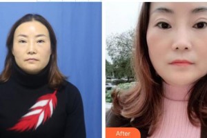 中國人民解放軍第四五七醫(yī)院陸海整形價(jià)格表附激光去眼袋案例展示