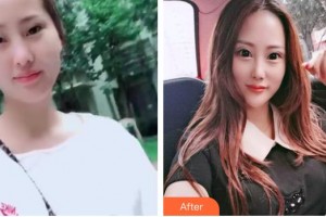 解放軍421醫(yī)院整形美容中心劉春利整形價格表附熱拉提案例展示