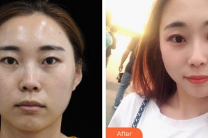 解放軍421醫(yī)院整形美容中心蒙喜永整形價(jià)格表附熱瑪吉案例展示
