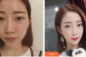 解放軍第三〇三醫(yī)院燒傷整形美容外科謝方明整形價(jià)格表附鼻部綜合案例展示