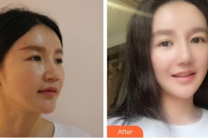 中國人民解放軍第一六三醫(yī)院整形美容中心劉麗芳整形價(jià)格表附假體隆鼻案例展示