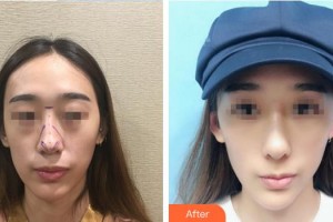 中國人民解放軍251醫(yī)院整形美容科全娟整形價(jià)格表附鼻部綜合案例展示