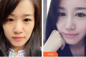 中國人民解放軍第一六三醫(yī)院整形美容中心吳丙整形價格表附硅膠隆鼻案例展示