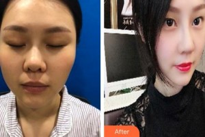 解放軍第159醫(yī)院燒傷整形美容康復(fù)中心袁仕安整形價格表附肋軟骨隆鼻案例展示