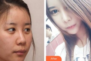 中國人民解放軍第一六三醫(yī)院整形美容中心易文林整形價格表附膨體隆鼻案例展示