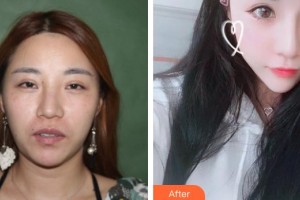 解放軍一八一醫(yī)院醫(yī)學(xué)整形美容科薄紅兵整形價格表附膨體隆鼻案例展示
