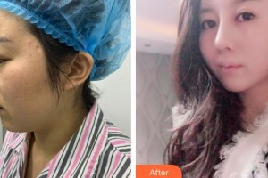 解放軍474醫(yī)院激光美容中心李紅整形價格表附鼻翼縮小案例展示
