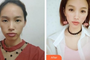 解放軍第一五八醫(yī)院整形美容中心廖柳整形價格表附鼻部綜合案例展示