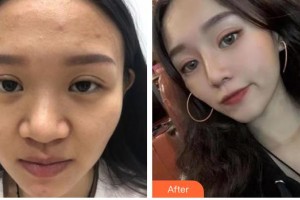 解放軍105醫(yī)院整形美容中心賈亮整形價格表附鼻部綜合案例展示