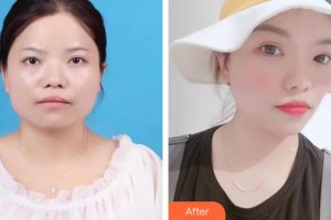 中國人民解放軍第100醫(yī)院整形美容中心孫守縣整形價格表附埋線提升案例展示