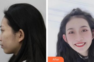 中國人民解放軍455胎記診療中心孫曉迪整形價格表附埋線提升案例展示